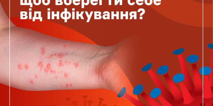 Що таке мавпяча віспа?